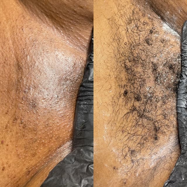 6 pack Brazilian at Dasha Sugar & Esthetix in Pittsburg, CA